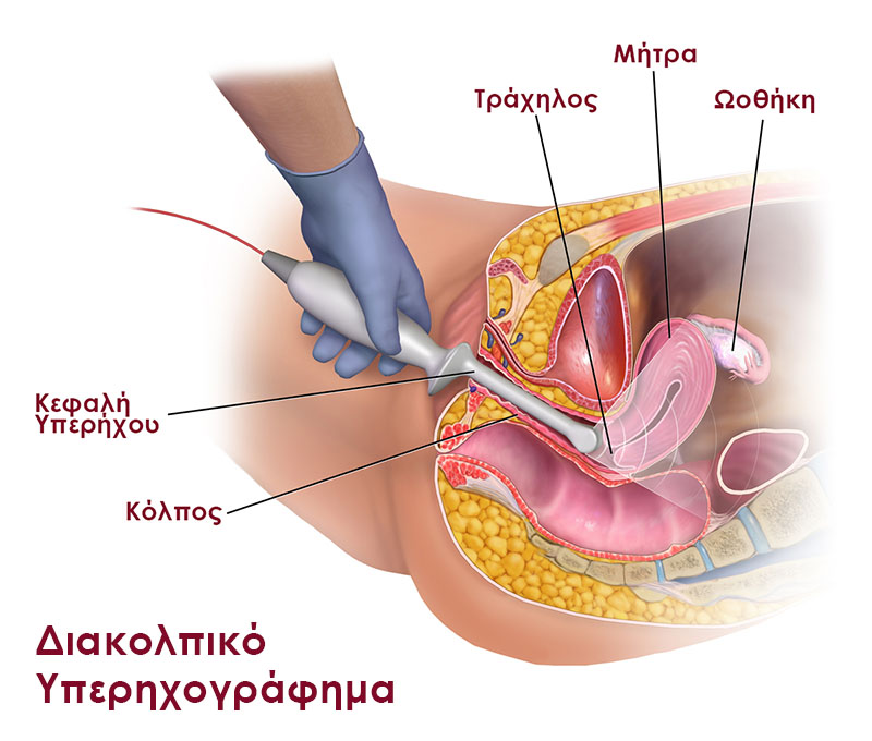 Γυναικολογικό Υπερηχογράφημα - Νικόλαος Σκαρτάδος Μαιευτήρας – Χειρουργός Γυναικολόγος, Διδάκτωρ Πανεπιστημίου Αθηνών