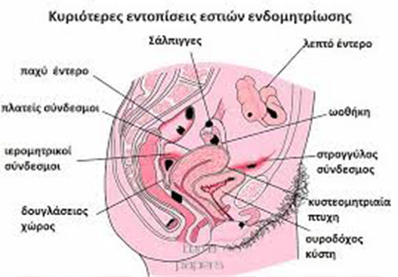 Ενδομητρίωση - Νικόλαος Σκαρτάδος Μαιευτήρας – Χειρουργός Γυναικολόγος, Διδάκτωρ Πανεπιστημίου Αθηνών