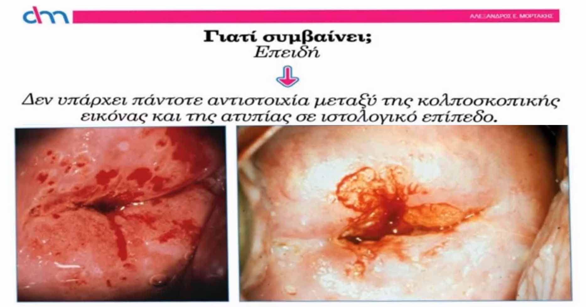 Τι είναι η κολποσκόπηση; - Νικόλαος Σκαρτάδος Μαιευτήρας – Χειρουργός Γυναικολόγος, Διδάκτωρ Πανεπιστημίου Αθηνών