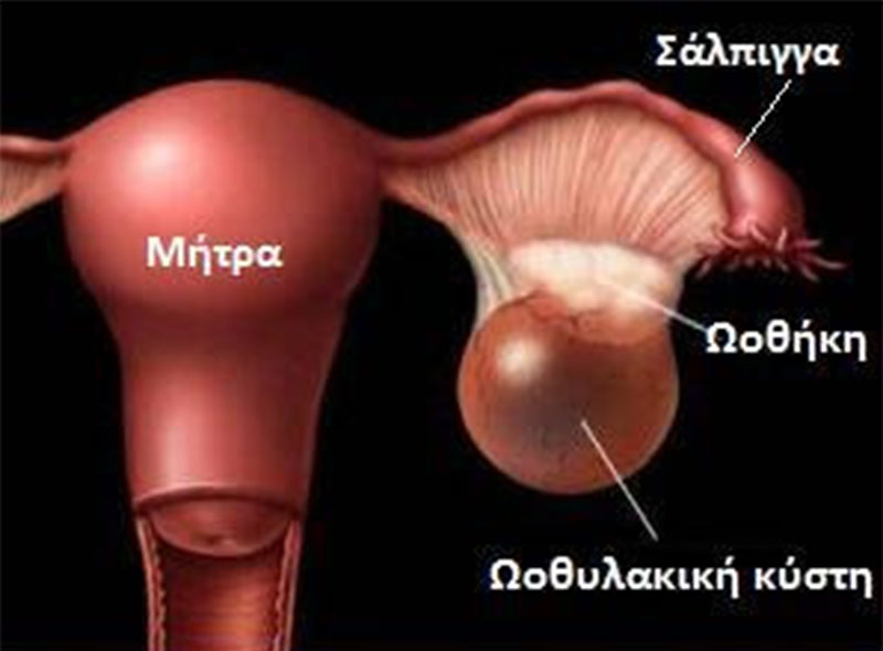 Κύστες Ωοθηκών - Νικόλαος Σκαρτάδος Μαιευτήρας – Χειρουργός Γυναικολόγος, Διδάκτωρ Πανεπιστημίου Αθηνών