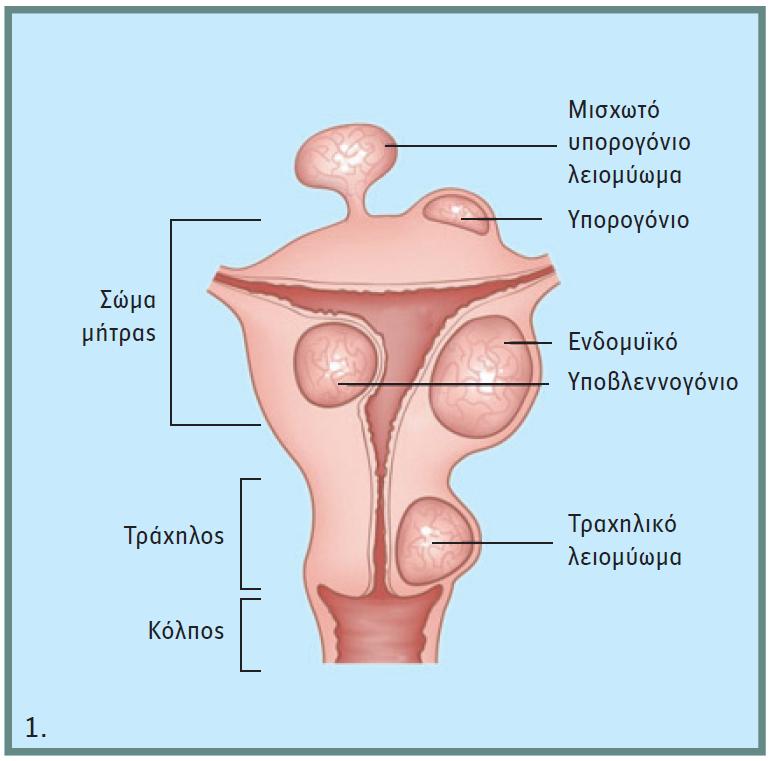 Παθήσεις Τραχήλου της Μήτρας - Νικόλαος Σκαρτάδος Μαιευτήρας – Χειρουργός Γυναικολόγος, Διδάκτωρ Πανεπιστημίου Αθηνών