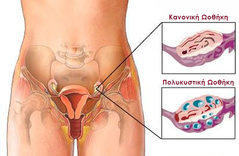 Πολυκυστικές ωοθήκες (PCO) - Νικόλαος Σκαρτάδος Μαιευτήρας – Χειρουργός Γυναικολόγος, Διδάκτωρ Πανεπιστημίου Αθηνών