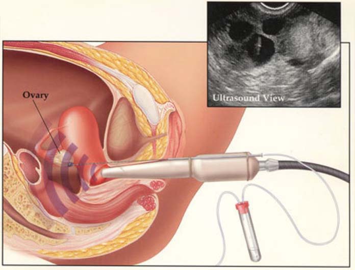 Τεχνικές Υποβοηθούμενης Αναπαραγωγής - Νικόλαος Σκαρτάδος Μαιευτήρας – Χειρουργός Γυναικολόγος, Διδάκτωρ Πανεπιστημίου Αθηνών